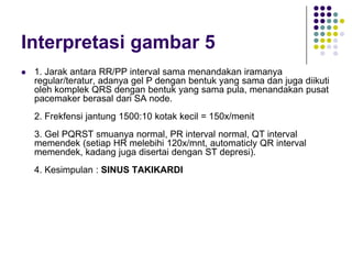 Interpretasi gambar 5
 1. Jarak antara RR/PP interval sama menandakan iramanya
regular/teratur, adanya gel P dengan bentuk yang sama dan juga diikuti
oleh komplek QRS dengan bentuk yang sama pula, menandakan pusat
pacemaker berasal dari SA node.
2. Frekfensi jantung 1500:10 kotak kecil = 150x/menit
3. Gel PQRST smuanya normal, PR interval normal, QT interval
memendek (setiap HR melebihi 120x/mnt, automaticly QR interval
memendek, kadang juga disertai dengan ST depresi).
4. Kesimpulan : SINUS TAKIKARDI
 