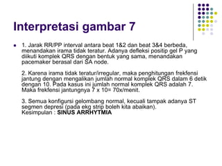 Interpretasi gambar 7
 1. Jarak RR/PP interval antara beat 1&2 dan beat 3&4 berbeda,
menandakan irama tidak teratur. Adanya defleksi positip gel P yang
diikuti komplek QRS dengan bentuk yang sama, menandakan
pacemaker berasal dari SA node.
2. Karena irama tidak teratur/irregular, maka penghitungan frekfensi
jantung dengan mengalikan jumlah normal komplek QRS dalam 6 detik
dengan 10. Pada kasus ini jumlah normal komplek QRS adalah 7.
Maka frekfensi jantungnya 7 x 10= 70x/menit.
3. Semua konfigursi gelombang normal, kecuali tampak adanya ST
segmen depresi (pada ekg strip boleh kita abaikan).
Kesimpulan : SINUS ARRHYTMIA
 