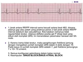  1. Jarak antara RR/PP interval sama kecuali antara beat 4&5, dimana
adanya gap atau jedah yang jaraknya persis 2 kali jarak antara RR/PP
interval sebelum dan sesudahnya. Kita katakan iramanya tidak
regular/tidak teratur. Adanya defleksi positip gel P ditiap beat yang
diikuti oleh komplek QRS, ini menandakan pacemaker berasal dari SA
node.
 2. Karena irama tidak teratur, maka penghitungan frekfensi jantung
dengan mengalikan jumlah komplek QRS dalam 6 detik dengan 10.
Pada kasus ini jumlah komplek QRS adalah 7, jadi frekfensi jantungnya
7 x 10= 70 x/menit.
3. Semua konfigurasi gelombang dalam batas normal.
4. Kesimpulan: SINUS BLOCK/SINUS ATRIAL BLOCK
 