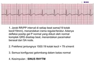 1. Jarak RR/PP interval di setiap beat sama(19 kotak
kecil/19mm), menandakan irama regular/teratur. Adanya
defleksi positip gel P normal yang diikuti oleh normal
komplek QRS disetiap beat, menandakan pacemaker
berasal dari SA node.
2. Frekfensi jantungnya 1500:19 kotak kecil = 79 x/menit
3. Semua konfigurasi gelombang dalam batas normal
4. Kesimpulan : SINUS RHYTM
 