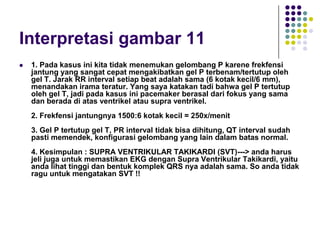 Interpretasi gambar 11
 1. Pada kasus ini kita tidak menemukan gelombang P karene frekfensi
jantung yang sangat cepat mengakibatkan gel P terbenam/tertutup oleh
gel T. Jarak RR interval setiap beat adalah sama (6 kotak kecil/6 mm),
menandakan irama teratur. Yang saya katakan tadi bahwa gel P tertutup
oleh gel T, jadi pada kasus ini pacemaker berasal dari fokus yang sama
dan berada di atas ventrikel atau supra ventrikel.
2. Frekfensi jantungnya 1500:6 kotak kecil = 250x/menit
3. Gel P tertutup gel T, PR interval tidak bisa dihitung, QT interval sudah
pasti memendek, konfigurasi gelombang yang lain dalam batas normal.
4. Kesimpulan : SUPRA VENTRIKULAR TAKIKARDI (SVT)---> anda harus
jeli juga untuk memastikan EKG dengan Supra Ventrikular Takikardi, yaitu
anda lihat tinggi dan bentuk komplek QRS nya adalah sama. So anda tidak
ragu untuk mengatakan SVT !!
 