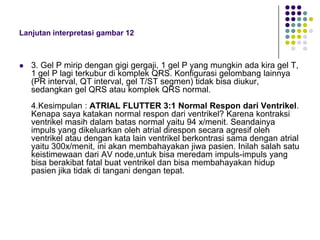 Lanjutan interpretasi gambar 12
 3. Gel P mirip dengan gigi gergaji, 1 gel P yang mungkin ada kira gel T,
1 gel P lagi terkubur di komplek QRS. Konfigurasi gelombang lainnya
(PR interval, QT interval, gel T/ST segmen) tidak bisa diukur,
sedangkan gel QRS atau komplek QRS normal.
4.Kesimpulan : ATRIAL FLUTTER 3:1 Normal Respon dari Ventrikel.
Kenapa saya katakan normal respon dari ventrikel? Karena kontraksi
ventrikel masih dalam batas normal yaitu 94 x/menit. Seandainya
impuls yang dikeluarkan oleh atrial direspon secara agresif oleh
ventrikel atau dengan kata lain ventrikel berkontrasi sama dengan atrial
yaitu 300x/menit, ini akan membahayakan jiwa pasien. Inilah salah satu
keistimewaan dari AV node,untuk bisa meredam impuls-impuls yang
bisa berakibat fatal buat ventrikel dan bisa membahayakan hidup
pasien jika tidak di tangani dengan tepat.
 