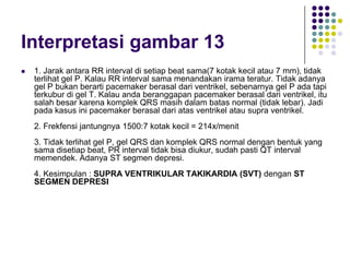 Interpretasi gambar 13
 1. Jarak antara RR interval di setiap beat sama(7 kotak kecil atau 7 mm), tidak
terlihat gel P. Kalau RR interval sama menandakan irama teratur. Tidak adanya
gel P bukan berarti pacemaker berasal dari ventrikel, sebenarnya gel P ada tapi
terkubur di gel T. Kalau anda beranggapan pacemaker berasal dari ventrikel, itu
salah besar karena komplek QRS masih dalam batas normal (tidak lebar). Jadi
pada kasus ini pacemaker berasal dari atas ventrikel atau supra ventrikel.
2. Frekfensi jantungnya 1500:7 kotak kecil = 214x/menit
3. Tidak terlihat gel P, gel QRS dan komplek QRS normal dengan bentuk yang
sama disetiap beat, PR interval tidak bisa diukur, sudah pasti QT interval
memendek. Adanya ST segmen depresi.
4. Kesimpulan : SUPRA VENTRIKULAR TAKIKARDIA (SVT) dengan ST
SEGMEN DEPRESI
 