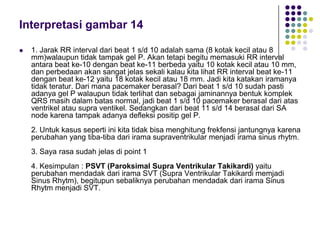Interpretasi gambar 14
 1. Jarak RR interval dari beat 1 s/d 10 adalah sama (8 kotak kecil atau 8
mm)walaupun tidak tampak gel P. Akan tetapi begitu memasuki RR interval
antara beat ke-10 dengan beat ke-11 berbeda yaitu 10 kotak kecil atau 10 mm,
dan perbedaan akan sangat jelas sekali kalau kita lihat RR interval beat ke-11
dengan beat ke-12 yaitu 18 kotak kecil atau 18 mm. Jadi kita katakan iramanya
tidak teratur. Dari mana pacemaker berasal? Dari beat 1 s/d 10 sudah pasti
adanya gel P walaupun tidak terlihat dan sebagai jaminannya bentuk komplek
QRS masih dalam batas normal, jadi beat 1 s/d 10 pacemaker berasal dari atas
ventrikel atau supra ventikel. Sedangkan dari beat 11 s/d 14 berasal dari SA
node karena tampak adanya defleksi positip gel P.
2. Untuk kasus seperti ini kita tidak bisa menghitung frekfensi jantungnya karena
perubahan yang tiba-tiba dari irama supraventrikular menjadi irama sinus rhytm.
3. Saya rasa sudah jelas di point 1
4. Kesimpulan : PSVT (Paroksimal Supra Ventrikular Takikardi) yaitu
perubahan mendadak dari irama SVT (Supra Ventrikular Takikardi memjadi
Sinus Rhytm), begitupun sebaliknya perubahan mendadak dari irama Sinus
Rhytm menjadi SVT.
 