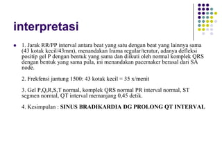 interpretasi
 1. Jarak RR/PP interval antara beat yang satu dengan beat yang lainnya sama
(43 kotak kecil/43mm), menandakan Irama regular/teratur, adanya defleksi
positip gel P dengan bentuk yang sama dan diikuti oleh normal komplek QRS
dengan bentuk yang sama pula, ini menandakan pacemaker berasal dari SA
node.
2. Frekfensi jantung 1500: 43 kotak kecil = 35 x/menit
3. Gel P,Q,R,S,T normal, komplek QRS normal PR interval normal, ST
segmen normal, QT interval memanjang 0,45 detik.
4. Kesimpulan : SINUS BRADIKARDIA DG PROLONG QT INTERVAL
 