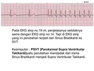 Pada EKG strip no.19 ini, penjelasanya setidaknya
sama dengan EKG strip no.14. Tapi di EKG strip
yang ini perubahan terjadi dari Sinus Bradikardi ke
SVT.
Kesimpulan : PSVT (Paroksimal Supra Ventrikular
Takikardi)yaitu perubahan mendadak dari irama
Sinus Bradikardi menjadi Supra Ventrikular Takikardi.
 