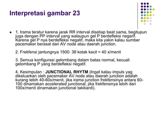 Interpretasi gambar 23
 1. Irama teratur karena jarak RR interval disetiap beat sama, begitupun
juga dengan PP interval yang walaupun gel P berdefleksi negarif.
Karena gel P nya berdefleksi negatif, maka kita yakin kalau sumber
pacemaker berasal dari AV node atau daerah junction.
2. Frekfensi jantungnya 1500: 38 kotak kecil = 40 x/menit
3. Semua konfigurasi gelombang dalam batas normal, kecuali
gelombang P yang berdefleksi negatif.
4. Kesimpulan : JUNCTIONAL RHYTM (Ingat kalau impuls yag
dikeluarkan oleh pacemaker AV node atau daerah junction adalah
kurang lebih 40-60x/menit, jika irama junction frekfensinya antara 60-
100 dinamakan accelerated junctional, jika frekfensinya lebih dari
100x/menit dinamakan junctional takikardi).
 