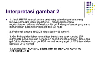 Interpretasi gambar 2
 1. Jarak RR/PP interval antara beat yang satu dengan beat yang
lainnya sama (23 kotak kecil/23mm), menandakan irama
regular/teratur, adanya defleksi positip gel P dengan bentuk yang sama
menandakan pacemaker berasal dari SA node
2. Frekfensi jantung 1500:23 kotak kecil = 65 x/menit
3. Gel P tinggi dan lebar normal tapi bentuknya agak runcing (?P
pulmonal), pada ekg strip penemuan seperti ini kita abaikan. Tidak ada
gel Q kita abaikan juga, gel RST normal. Adanya gel U, QT interval dan
komplek QRS normal
4. Kesimpulan : NORMAL SINUS RHYTM DENGAN ADANYA
GELOMBANG U
 