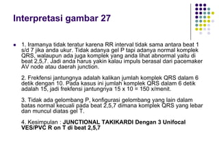 Interpretasi gambar 27
 1. Iramanya tidak teratur karena RR interval tidak sama antara beat 1
s/d 7 jika anda ukur. Tidak adanya gel P tapi adanya normal komplek
QRS, walaupun ada juga komplek yang anda lihat abnormal yaitu di
beat 2,5,7. Jadi anda harus yakin kalau impuls berasal dari pacemaker
AV node atau daerah junction.
2. Frekfensi jantungnya adalah kalikan jumlah komplek QRS dalam 6
detik dengan 10. Pada kasus ini jumlah komplek QRS dalam 6 detik
adalah 15, jadi frekfensi jantungnya 15 x 10 = 150 x/menit.
3. Tidak ada gelombang P, konfigurasi gelombang yang lain dalam
batas normal kecuali pada beat 2,5,7 dimana komplek QRS yang lebar
dan muncul diatas gel T.
4. Kesimpulan : JUNCTIONAL TAKIKARDI Dengan 3 Unifocal
VES/PVC R on T di beat 2,5,7
 