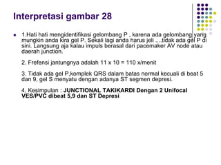 Interpretasi gambar 28
 1.Hati hati mengidentifikasi gelombang P , karena ada gelombang yang
mungkin anda kira gel P. Sekali lagi anda harus jeli ....tidak ada gel P di
sini. Langsung aja kalau impuls berasal dari pacemaker AV node atau
daerah junction.
2. Frefensi jantungnya adalah 11 x 10 = 110 x/menit
3. Tidak ada gel P,komplek QRS dalam batas normal kecuali di beat 5
dan 9, gel S menyatu dengan adanya ST segmen depresi.
4. Kesimpulan : JUNCTIONAL TAKIKARDI Dengan 2 Unifocal
VES/PVC dibeat 5,9 dan ST Depresi
 