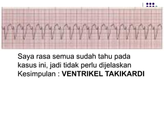 Saya rasa semua sudah tahu pada
kasus ini, jadi tidak perlu dijelaskan
Kesimpulan : VENTRIKEL TAKIKARDI
 