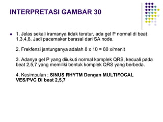 INTERPRETASI GAMBAR 30
 1. Jelas sekali iramanya tidak teratur, ada gel P normal di beat
1,3,4,8. Jadi pacemaker berasal dari SA node.
2. Frekfensi jantunganya adalah 8 x 10 = 80 x/menit
3. Adanya gel P yang diiukuti normal komplek QRS, kecuali pada
beat 2,5,7 yang memiliki bentuk komplek QRS yang berbeda.
4. Kesimpulan : SINUS RHYTM Dengan MULTIFOCAL
VES/PVC Di beat 2,5,7
 