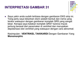 INTERPRETASI GAMBAR 31
 Saya yakin anda sudah terbiasa dengan gambaran EKG strip ini.
Yang perlu saya tekankan disini adalah bentuk dan irama yang
teratur walaupun dengan gambaran komplek QRS yang sangat
lebar. Kenapa saya katakan komplek QRS? karena impuls
jantung berasal dari pacemaker di ventrikel dan merupakan
depolarisasi otot ventrikel yang walaupun dengan cara abnormal.
Kesimpulan : VENTRIKEL TAKIKARDI Dengan Gambaran Yang
Monomorphic
 