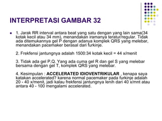 INTERPRETASI GAMBAR 32
 1. Jarak RR interval antara beat yang satu dengan yang lain sama(34
kotak kecil atau 34 mm), menandakan iramanya teratur/regular. Tidak
ada ditemukannya gel P dengan adanya komplek QRS yang melebar,
menandakan pacemaker berasal dari furkinje.
2. Frekfensi jantungnya adalah 1500:34 kotak kecil = 44 x/menit
3. Tidak ada gel P,Q. Yang ada cuma gel R dan gel S yang melebar
bersama dengan gel T, komplek QRS yang melebar.
4. Kesimpulan : ACCELERATED IDIOVENTRIKULAR , kenapa saya
katakan accelerated? karena normal pacemaker pada furkinje adalah
20 - 40 x/menit, jadi kalau frekfensi jantungnya lenih dari 40 x/mnt atau
antara 40 - 100 mengalami accelerated.
 