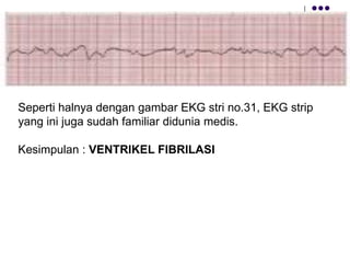 Seperti halnya dengan gambar EKG stri no.31, EKG strip
yang ini juga sudah familiar didunia medis.
Kesimpulan : VENTRIKEL FIBRILASI
 