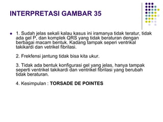 INTERPRETASI GAMBAR 35
 1. Sudah jelas sekali kalau kasus ini iramanya tidak teratur, tidak
ada gel P, dan komplek QRS yang tidak beraturan dengan
berbagai macam bentuk. Kadang tampak seperi ventrikal
takikardi dan vetrikel fibrilasi.
2. Frekfensi jantung tidak bisa kita ukur.
3. Tidak ada bentuk konfigurasi gel yang jelas, hanya tampak
seperti ventrikel takikardi dan ventrikel fibrilasi yang berubah
tidak beraturan.
4. Kesimpulan : TORSADE DE POINTES
 