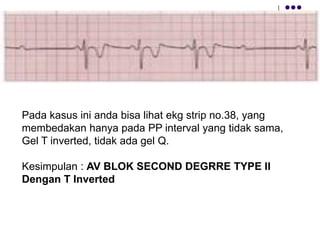 Pada kasus ini anda bisa lihat ekg strip no.38, yang
membedakan hanya pada PP interval yang tidak sama,
Gel T inverted, tidak ada gel Q.
Kesimpulan : AV BLOK SECOND DEGRRE TYPE II
Dengan T Inverted
 