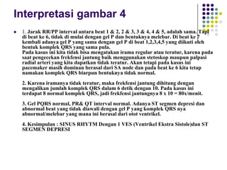 Interpretasi gambar 4
 1. Jarak RR/PP interval antara beat 1 & 2, 2 & 3, 3 & 4, 4 & 5, adalah sama. Tapi
di beat ke 6, tidak di mulai dengan gel P dan bentuknya melebar. Di beat ke 7
kembali adanya gel P yang sama dengan gel P di beat 1,2,3,4,5 yang diikuti oleh
bentuk komplek QRS yang sama pula.
Pada kasus ini kita tidak bisa mengatakan irama regular atau teratur, karena pada
saat pengecekan frekfensi jantung baik menggunakan stetoskop maupun palpasi
radial arteri yang kita dapatkan tidak teratur. Akan tetapi pada kasus ini
pacemaker masih dominan berasal dari SA node dan pada beat ke 6 kita tetap
namakan komplek QRS biarpun bentuknya tidak normal.
2. Karena iramanya tidak teratur, maka frekfensi jantung dihitung dengan
mengalikan jumlah komplek QRS dalam 6 detik dengan 10. Pada kasus ini
terdapat 8 normal komplek QRS, jadi frekfensi jantungnya 8 x 10 = 80x/menit.
3. Gel PQRS normal, PR& QT interval normal. Adanya ST segmen depresi dan
abnormal beat yang tidak diawali dengan gel P yang komplek QRS nya
abnormal/melebar yang mana ini berasal dari otot ventrikel.
4. Kesimpulan : SINUS RHYTM Dengan 1 VES (Ventrikel Ekstra Sistole)dan ST
SEGMEN DEPRESI
 
