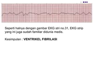 Seperti halnya dengan gambar EKG stri no.31, EKG strip
yang ini juga sudah familiar didunia medis.
Kesimpulan : VENTRIKEL ...
