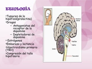 ETIOLOGÍA
•Tumores de la
hipófisis(prolactina)
•Drogas
– Antagonistas del
receptor de la
dopamina
– Depletadores de
dopamina
• Estrógenos
•Embarazo y lactancia
•Hipotiroidismo primario
(TRH)
•Compresión del tallo
hipofisario
 