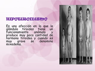 HIPOTIROIDISMO
Es una afección en la que la
glándula tiroides tiene un
funcionamiento anómalo y
produce muy poca cantidad de
hormona tiroidea y cuando es
muy grave se denomina
mixedema.
 