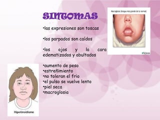 SINTOMAS
•las expresiones son toscas
•los parpados son caídos
•los ojos y la cara
edematizados y abultados
•aumento de peso
•estreñimiento
•no toleran el frio
•el pulso se vuelve lento
•piel seca
•macroglosia
 