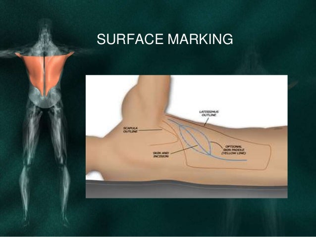 Latissimus dorsi flap for reconstruction in head and neck deffects