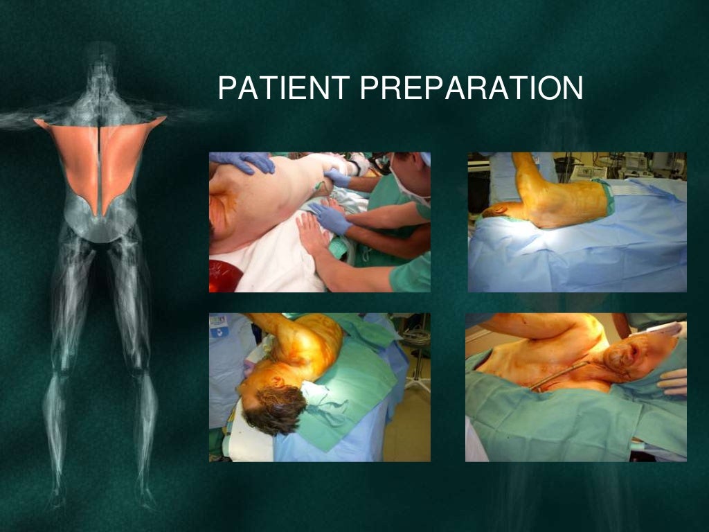 Latissimus dorsi flap for reconstruction in head and neck deffects
