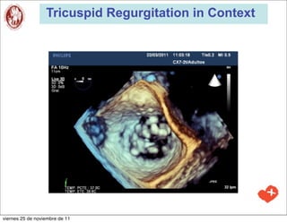 Tricuspid Regurgitation in Context




viernes 25 de noviembre de 11
 