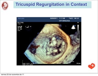 Tricuspid Regurgitation in Context




viernes 25 de noviembre de 11
 