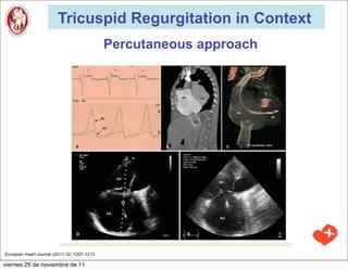 Tricuspid Regurgitation in Context
                                              Percutaneous approach




European Heart Journal (2011) 32, 1207–1213

viernes 25 de noviembre de 11
 