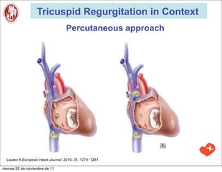 Tricuspid Regurgitation in Context
                                   Percutaneous approach




  Lauten A European Heart Journal 2010: 31, 1274–1281

viernes 25 de noviembre de 11
 