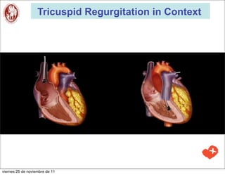 Tricuspid Regurgitation in Context




viernes 25 de noviembre de 11
 