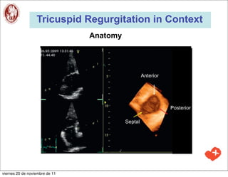 Tricuspid Regurgitation in Context
                                Anatomy




                                                   Anterior




                                                              Posterior

                                          Septal




viernes 25 de noviembre de 11
 