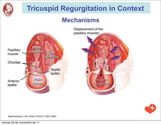 Tricuspid Regurgitation in Context
                                                    Mechanisms




     Mascherbauer J Eur Heart J 2010;31:2841-2843

viernes 25 de noviembre de 11
 