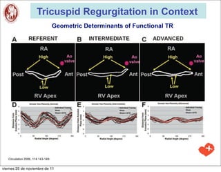 Tricuspid Regurgitation in Context
                                    Geometric Determinants of Functional TR




   Circulation 2006, 114:143-149:


viernes 25 de noviembre de 11
 