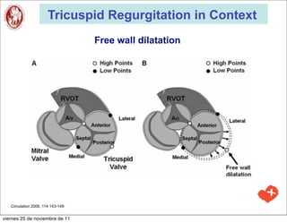 Tricuspid Regurgitation in Context
                                    Free wall dilatation




   Circulation 2006, 114:143-149:


viernes 25 de noviembre de 11
 