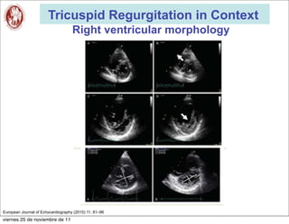 Tricuspid Regurgitation in Context
                                    Right ventricular morphology




European Journal of Echocardiography (2010) 11, 81–96
viernes 25 de noviembre de 11
 