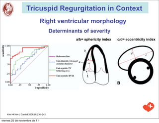 Tricuspid Regurgitation in Context
                                 Right ventricular morphology
                                          Determinants of severity
                                                    a/b= sphericity index   c/d= eccentricity index




    Kim HK Am J Cardiol 2006;98:236–242

viernes 25 de noviembre de 11
 