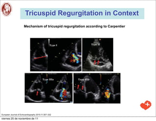 Tricuspid Regurgitation in Context
                       Mechanism of tricuspid regurgitation according to Carpentier




European Journal of Echocardiography 2010;11:307–332

viernes 25 de noviembre de 11
 
