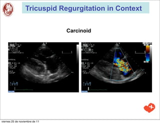 Tricuspid Regurgitation in Context


                                Carcinoid




viernes 25 de noviembre de 11
 