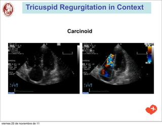 Tricuspid Regurgitation in Context


                                Carcinoid




viernes 25 de noviembre de 11
 