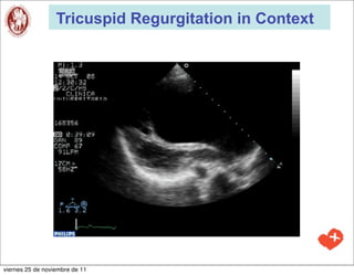 Tricuspid Regurgitation in Context




viernes 25 de noviembre de 11
 