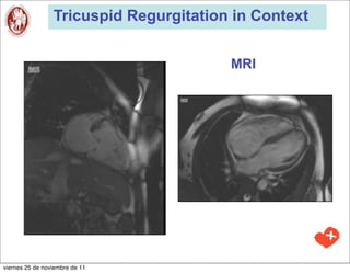 Tricuspid Regurgitation in Context


                                        MRI




viernes 25 de noviembre de 11
 