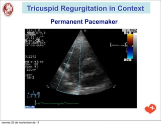 Tricuspid Regurgitation in Context
                                Permanent Pacemaker




viernes 25 de noviembre de 11
 