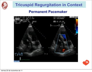 Tricuspid Regurgitation in Context
                                Permanent Pacemaker




viernes 25 de noviembre de 11
 