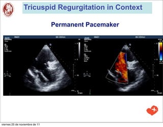 Tricuspid Regurgitation in Context

                                Permanent Pacemaker




viernes 25 de noviembre de 11
 