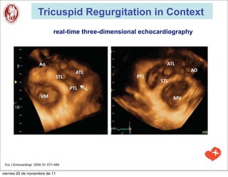 Tricuspid Regurgitation in Context
                                real-time three-dimensional echocardiography




 Eur J Echocardiogr 2009;10: 477–484

viernes 25 de noviembre de 11
 