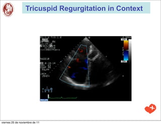 Tricuspid Regurgitation in Context




viernes 25 de noviembre de 11
 