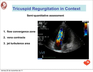 Tricuspid Regurgitation in Context
                                Semi-quantitative assessment




   1. flow convergence zone

   2. vena contracta

   3. jet turbulence area




viernes 25 de noviembre de 11
 